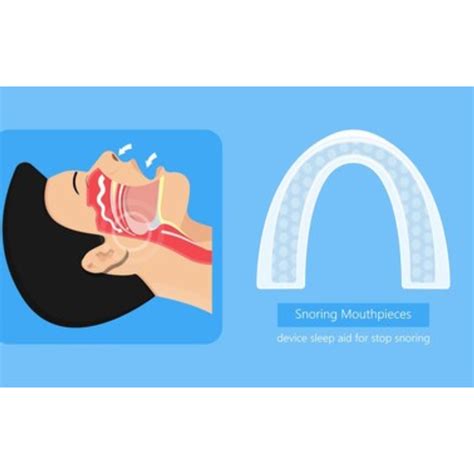 Mouth Guards for Sleep Apnea: What You Need to Know - Smile Studio Boston