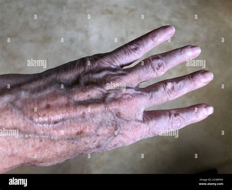 Age spots on the hand of a 72-year-old woman Stock Photo - Alamy