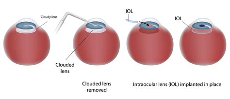 Cataract Surgery