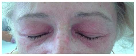 Anti-MDA5 Amyopathic Dermatomyositis—A Diagnostic and Therapeutic Challenge
