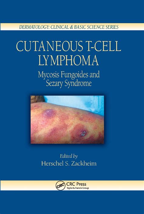 Buy Cutaneous T-Cell Lymphoma: Mycosis Fungoides and Sezary Syndrome ...