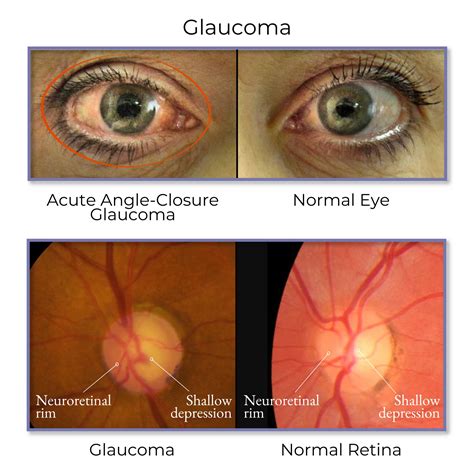 Open Eye Glaucoma Glaucoma Specialist Virginia | Glaucoma Treatment