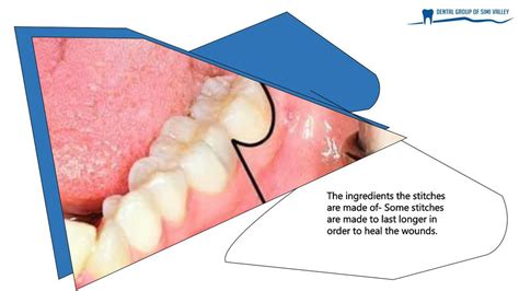 PPT - What to Know About Dissolvable Stitches After Wisdom Teeth Removal PowerPoint Presentation ...