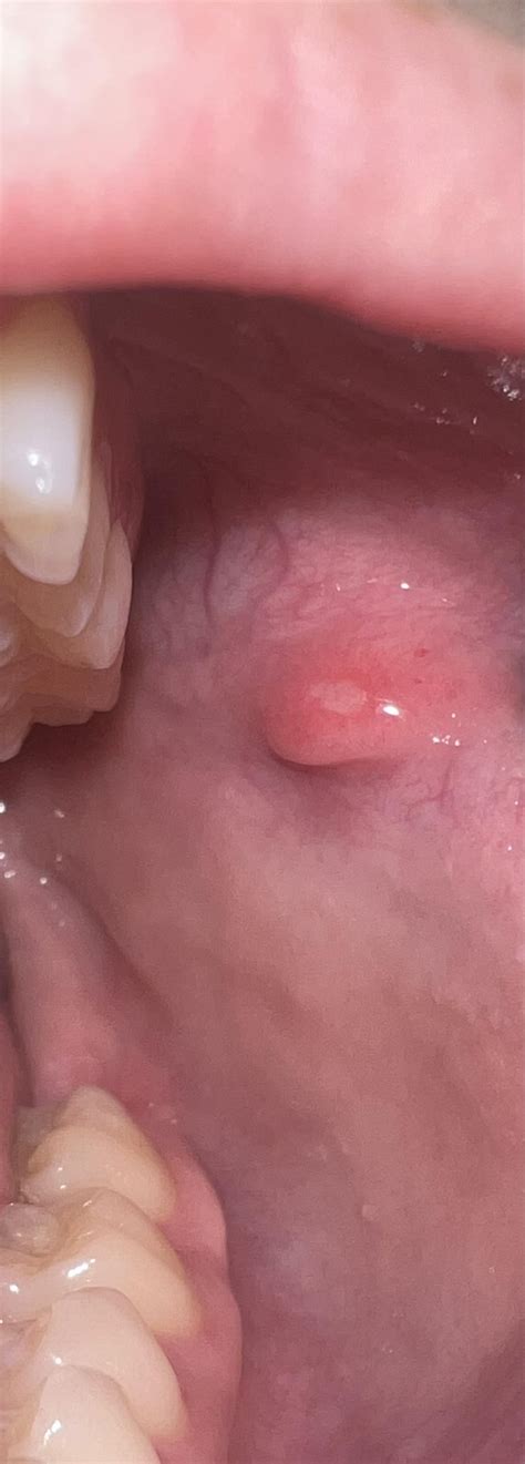 21F Tissue lump? With canker sore. Don’t recall biting my cheek. What ...