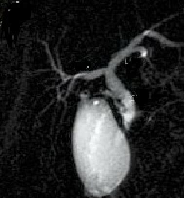 Image result for MRCP Biliary Tree