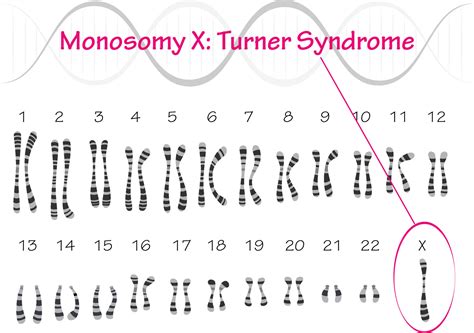 Monosomy 21