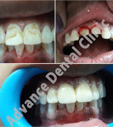 Best Dental in Outram Line - Advance Dental Clinic