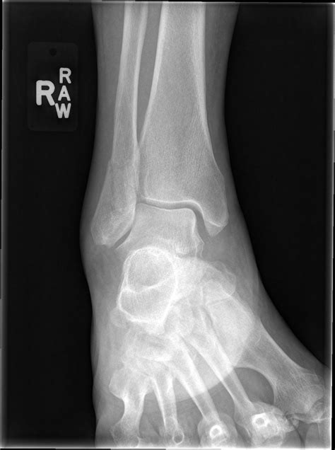 Spiral Fracture Tibia Fibula