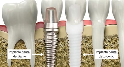 Best Dentist for Implant | Dental Implant Clinic