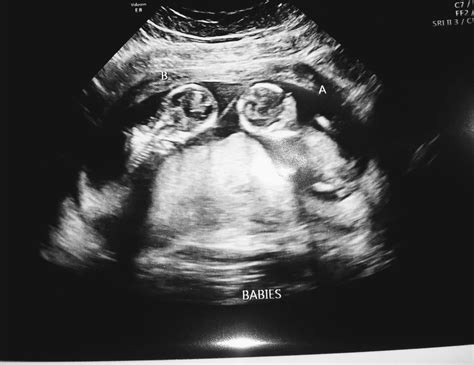 13 Weeks Pregnant Ultrasound