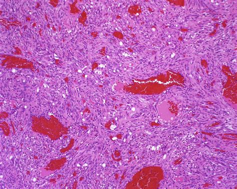 Histopathology of Spindle Cell Vascular Tumors - Surgical Pathology Clinics
