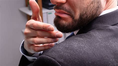 10 Ways to Treat and Prevent Dandruff - Elegant G Barbershop