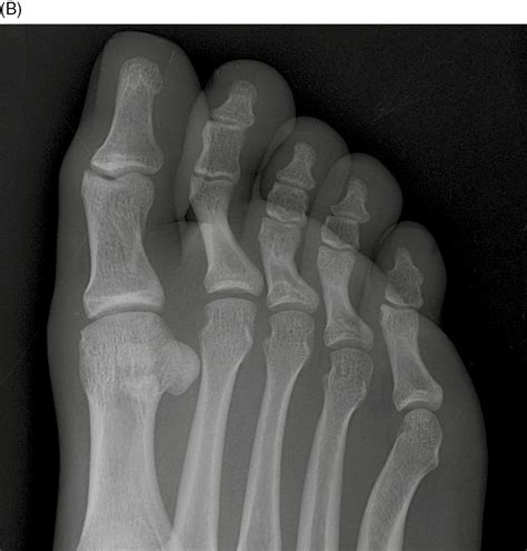 Proximal Phalanx Fracture