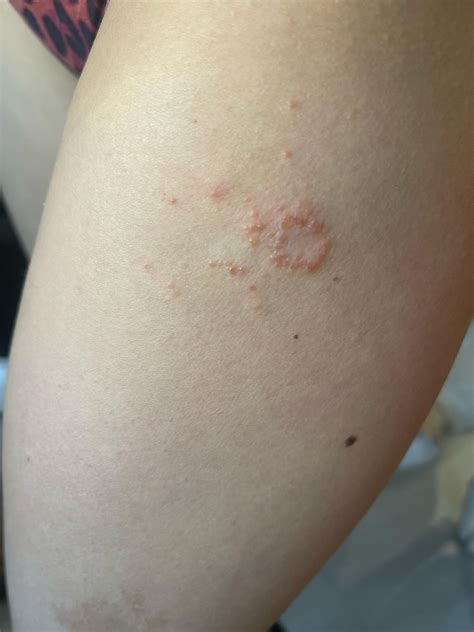 How to treat this ringworm. Have had it over a month and won’t go away with OTC clotrimazole ...