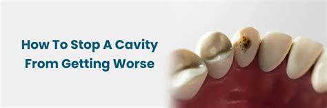 Preventing Cavities: How to Stop Them from Worsening