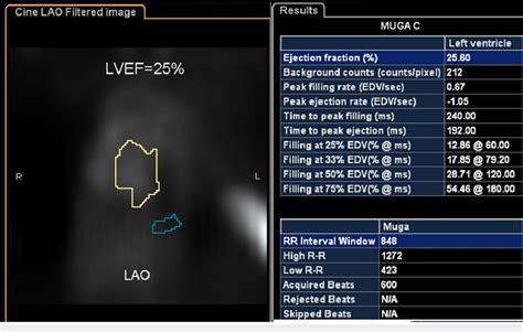 Image result for Muga Scan Lab Results