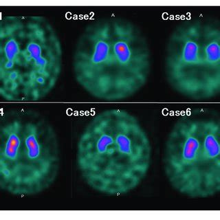 Image result for Dat SPECT Scan
