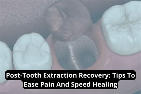 Post Tooth Extraction Healing 的图像结果