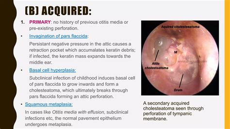 Cholesteatoma | PPTX