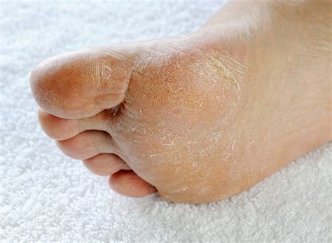 Athlete's Foot Treatment | U.S. Dermatology Partners
