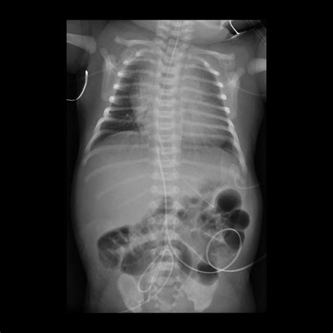 Umbilical Venous Catheter Malfunction / Malposition / Misposition ...