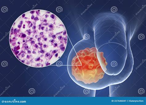 Testicular Cancer, 3D Illustration and Light Micrograph Stock Illustration - Illustration of ...