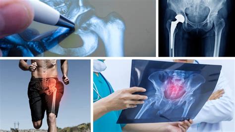 Hip Problem Pain 的图像结果