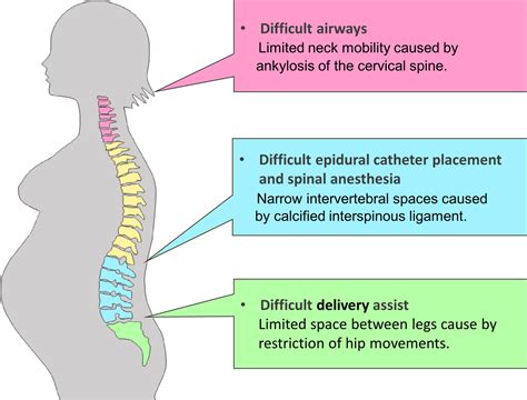Management of pregnancy complicated by ankylosing spondylitis: A case ...