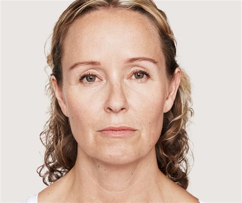 Discover Dysport® Injections | Benefits and What to Expect