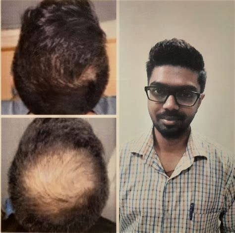 Skinsense treatments for hair loss: 22-year-old | Dr Shweta Iyengar ...