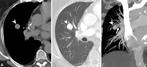 CT Appearance of Pulmonary Arteriovenous Malformations and Mimics | RadioGraphics