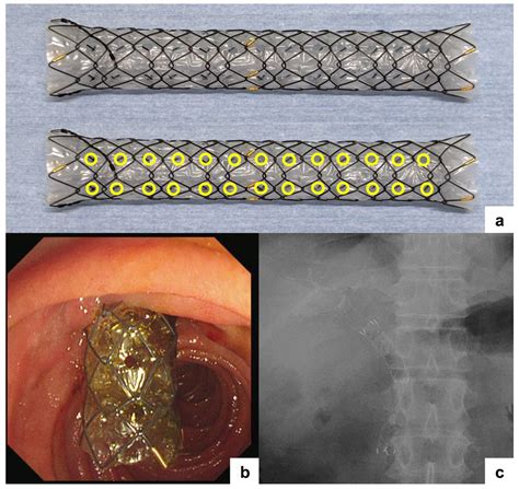 Multi-Hole Self-Expandable Metallic Stent for Malignant Distal Biliary ...