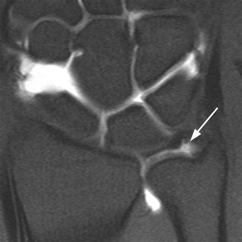 Peripheral Tear of the Triangular Fibrocartilage: Depiction with MR ...