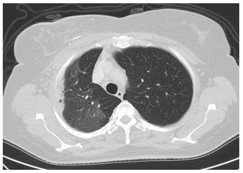 External Beam Accelerated Partial Breast Irradiation in Early Breast ...