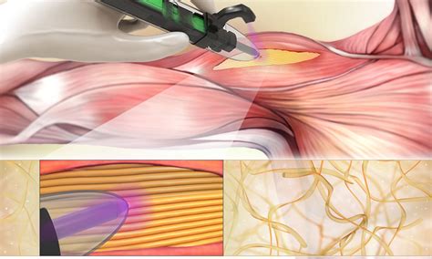 Handheld 3D printers developed to treat musculoskeletal injuries