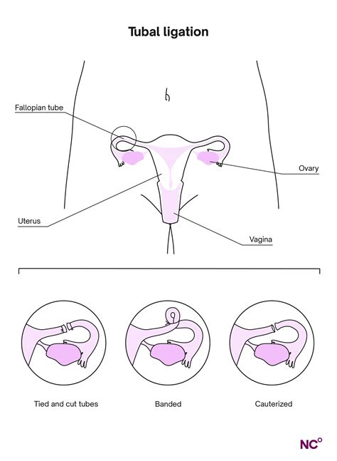 Side Effects From Tubes Tied
