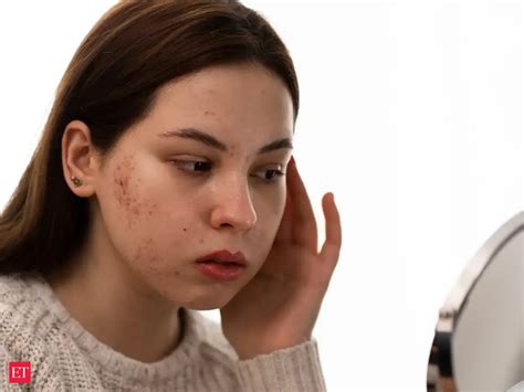 Acne-prone skin? These are the BEST foods to manage it NATURALLY ...