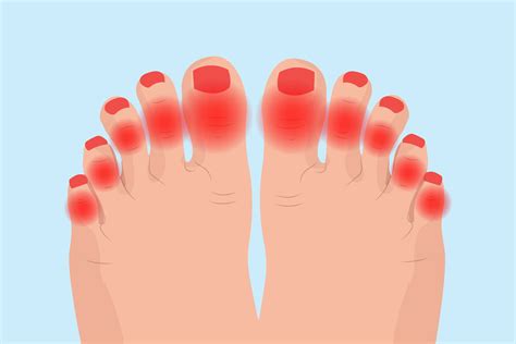 Arthritis in Toes - Symptoms, Causes, Diagnosis, and Treatment