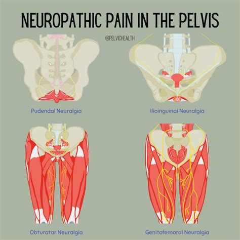 Neuropathic Pelvic Pain: Beyond Pudendal Neuralgia
