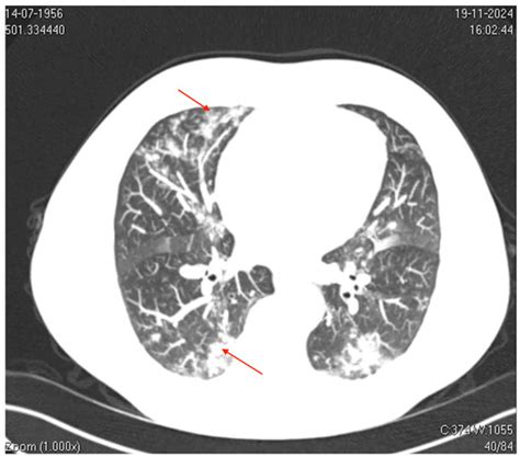 The Silent Threat of Human Metapneumovirus: Clinical Challenges and ...