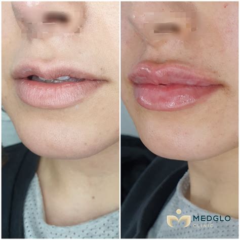 Lip Fillers - Medglo Clinic
