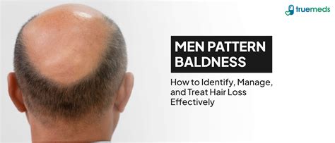 Male Pattern Baldness: Symptoms, Causes, Stages & Treatment