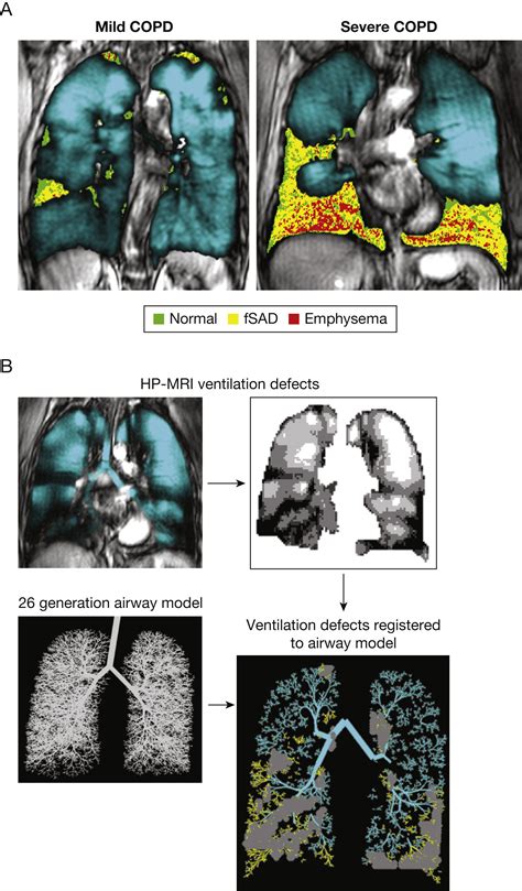 Seven Pillars of Small Airways Disease in Asthma and COPD - CHEST