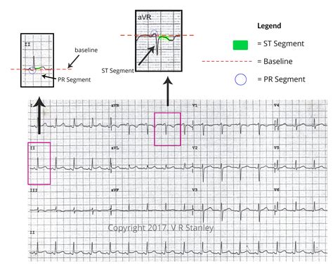 ECG Changes in Pericarditis | STEMI vs Pericarditis on ECG ECGcourse.com