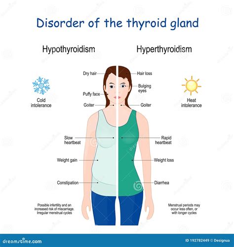 Hypothyroidism Hyperthyroidism: Differences And Symptoms, 49% OFF