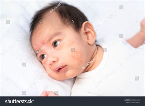 Pityriasis Alba Baby