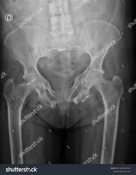 Pelvis Woman Signs Previous Fractures Ischiopubic Stock Photo ...