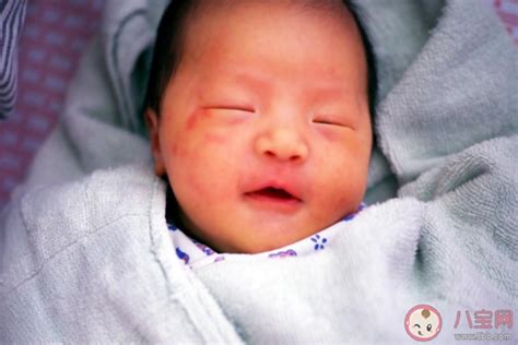 刚刚出生的婴儿黄疸怎么治疗-京东健康