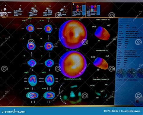 Color Adenosine Cardiac Stress Test Images on Black Background Stock ...