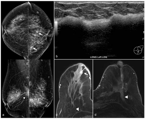 Imaging Features Following Breast Explant Surgery: A Pictorial Essay
